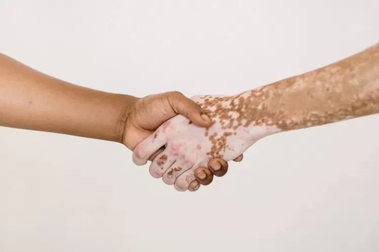Simak penyebab dan gejala penyakit vitiligo  (Pexels.com/Armin Rimoldi )
