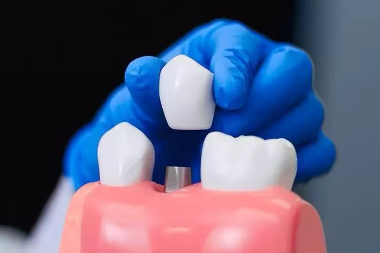 implan gigi merupakan prosedur penanaman titanium pada bagian rahang gigi sebagai pengganti akar gigi yang sudah tanggal (Gorajuara/tanyapepsodent.com)