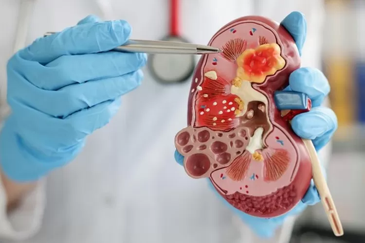 Ilustrasi Gangguan Ginjal Akut. Gettyimages