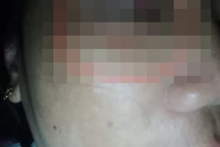 Seorang ibu warga Medan Labuhan diduga jadi korban KDRT suaminya