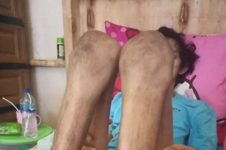 Pasien RSUD Kota Bogor usai menjalani operasi tulang punggung