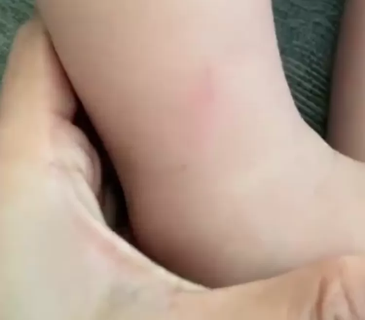  Terdapat cakaran pada kaki bayi hingga membuatnya nangis kejer.