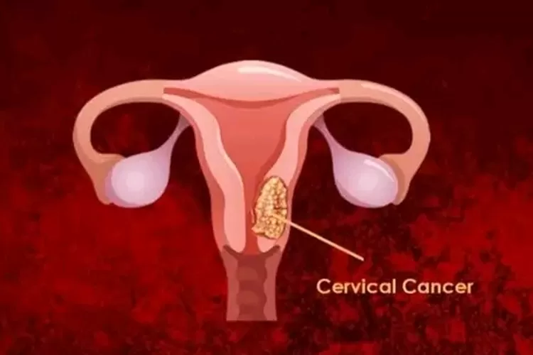 Ilustrasi 3 gejala kanker serviks (Facebook / Husnah Khoiryah Nasa)