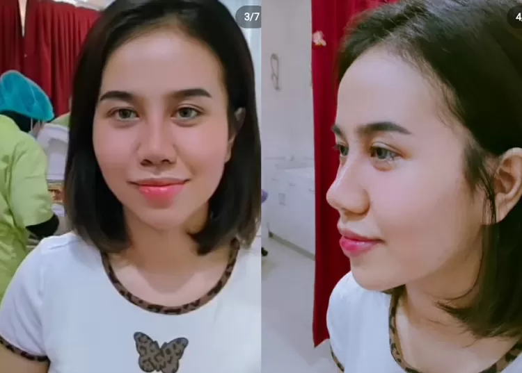 penampkan hidung Mayang usai dilakukan operasi plastik