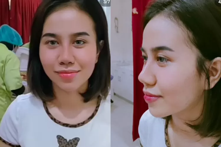 usai Mayang Oplas hidung malah di hujat warganet (foto; dok/instagram @dodysoedrajat_1)