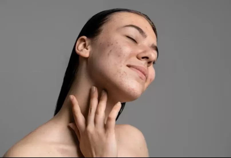 Foto ilustrasi wanita dewasa melakukan perawatan wajah untuk menghilangkan jerawat. (Freepik)