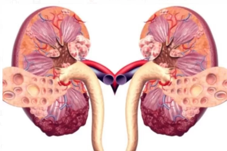 Ginjal salah satu organ tubuh yang sangat penting dan harus dijaga kesehatannya. 