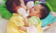 Bayi Kembar Siam di Sukabumi Butuh Biaya Rp1,6 Miliar untuk Memisahkannya